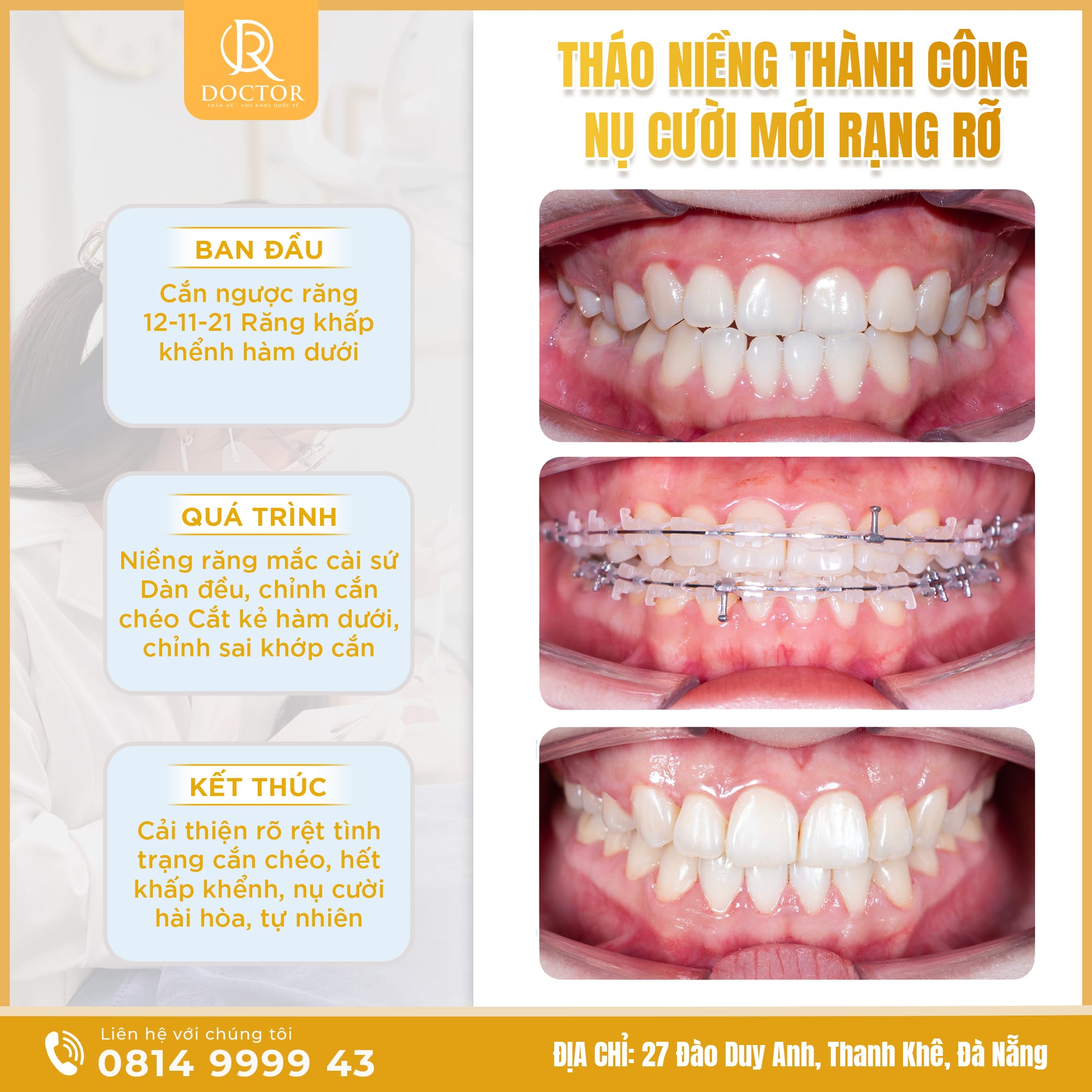 Hình ảnh tháo niềng răng thành công tại Nha Khoa Doctor Đà Nẵng, cho thấy sự thay đổi rõ rệt của hàm răng sau quá trình chỉnh nha và giúp tăng độ tin cậy cho bài viết niềng răng.