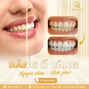Hình ảnh minh họa răng ố vàng trước và sau khi tẩy trắng răng tại Nha khoa Quốc Tế Doctor Đà Nẵng, giúp người xem dễ hình dung hiệu quả cải thiện màu răng.