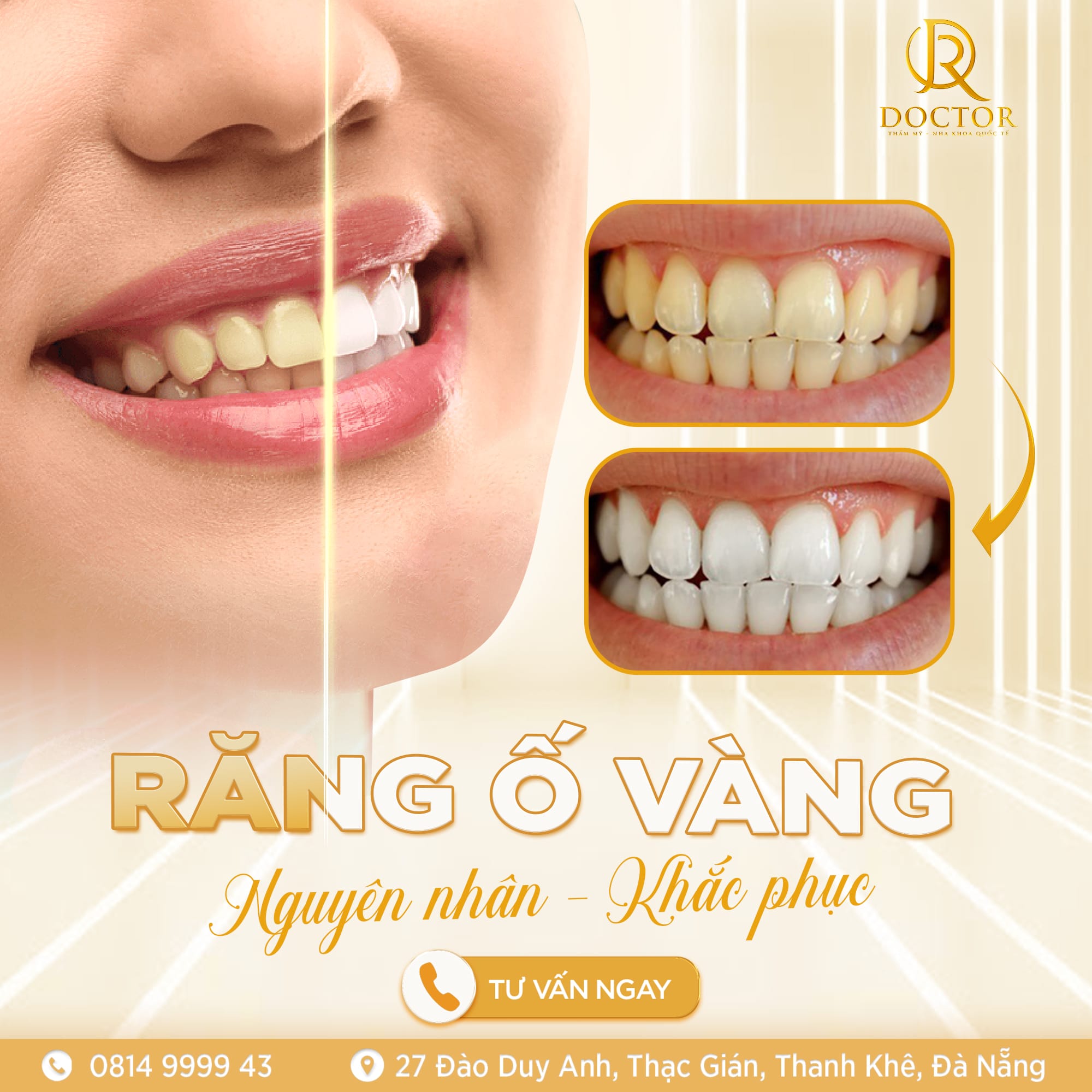 Hình ảnh minh họa răng ố vàng trước và sau khi tẩy trắng răng tại Nha khoa Quốc Tế Doctor Đà Nẵng, giúp người xem dễ hình dung hiệu quả cải thiện màu răng.