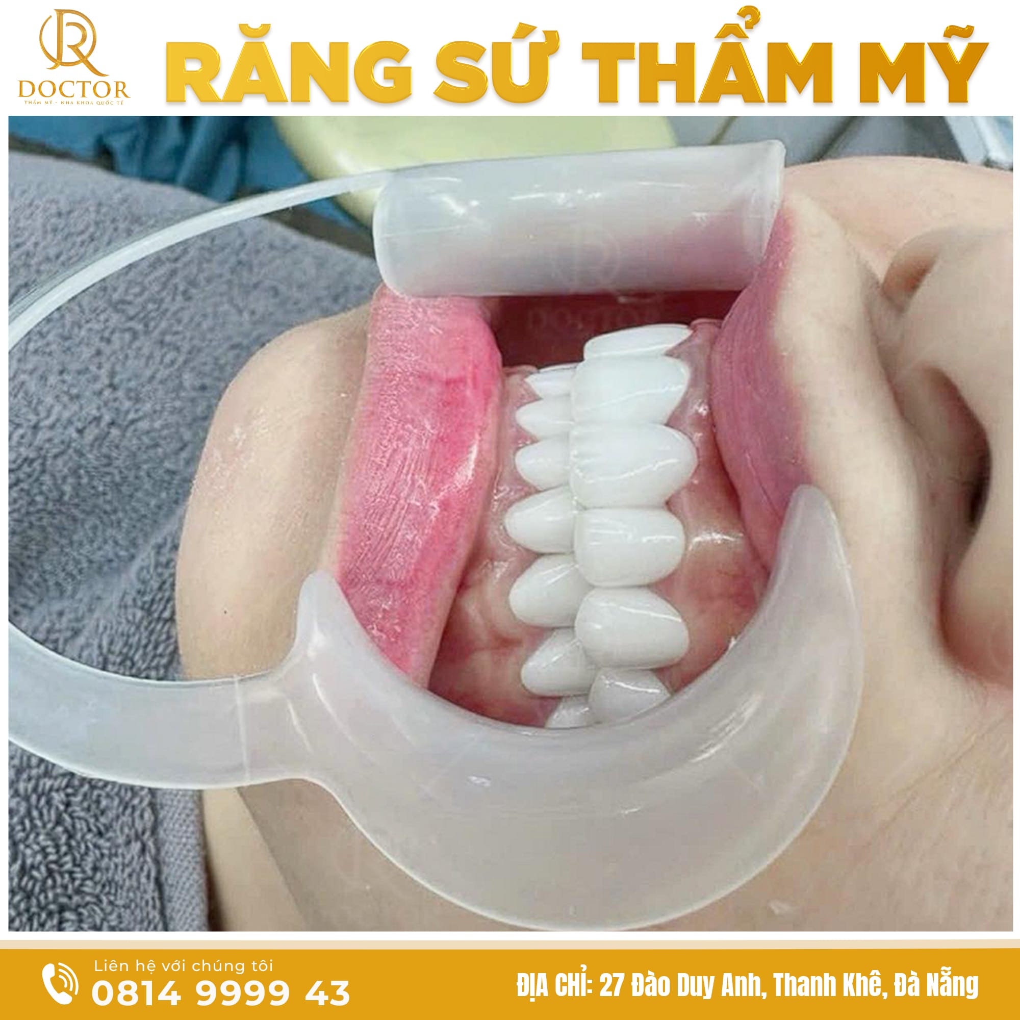 Hình ảnh thực tế răng sứ thẩm mỹ sau khi dán sứ Veneer tại Nha Khoa Doctor Đà Nẵng, giúp cải thiện màu sắc và hình dáng răng tự nhiên.