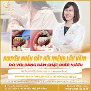 Nguyên nhân gây hôi miệng lâu năm do vôi răng bám chặt dưới nướu.
