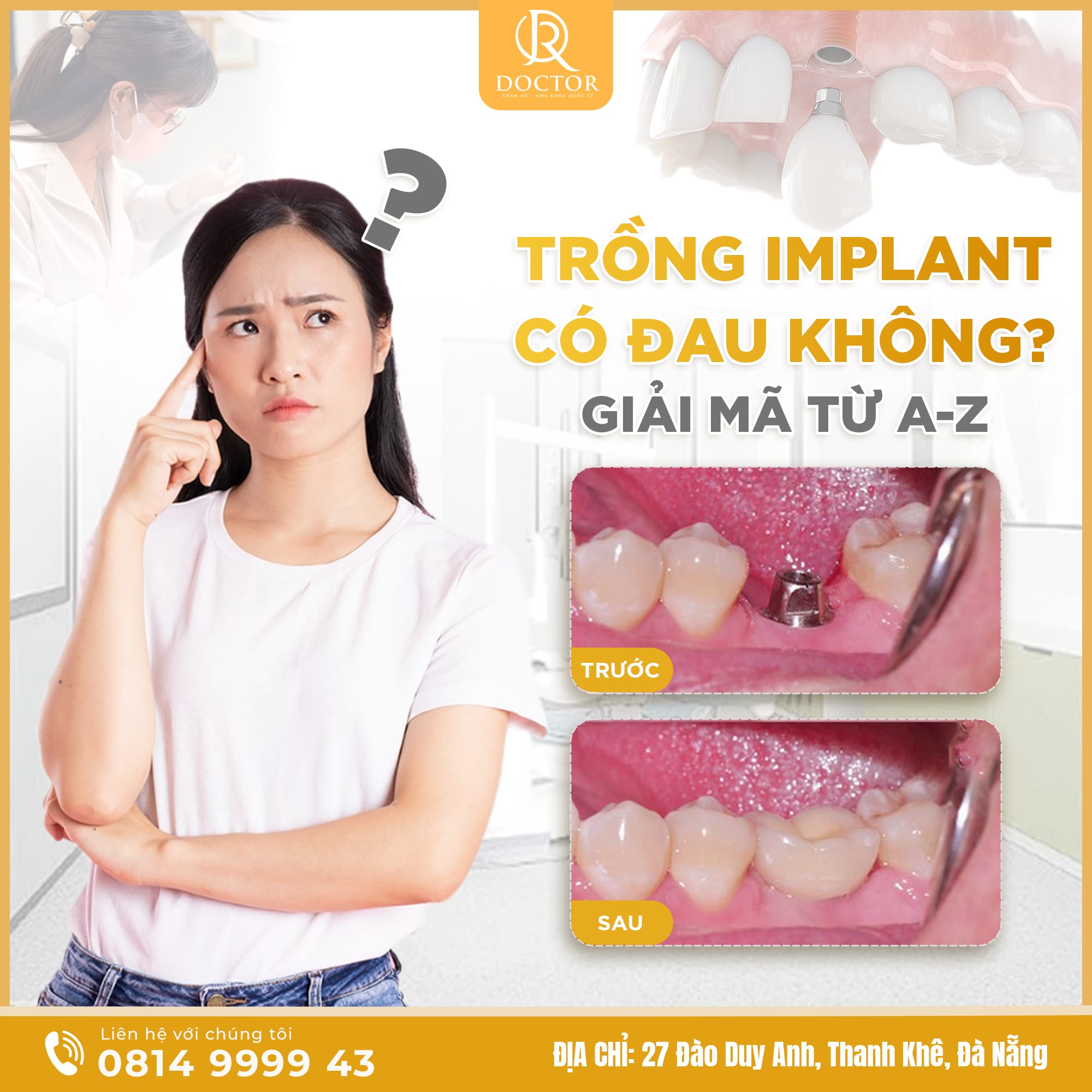 Trồng răng Implant Đà Nẵng giá tốt 2026 Trồng răng Implant Đà Nẵng giá tốt 2026