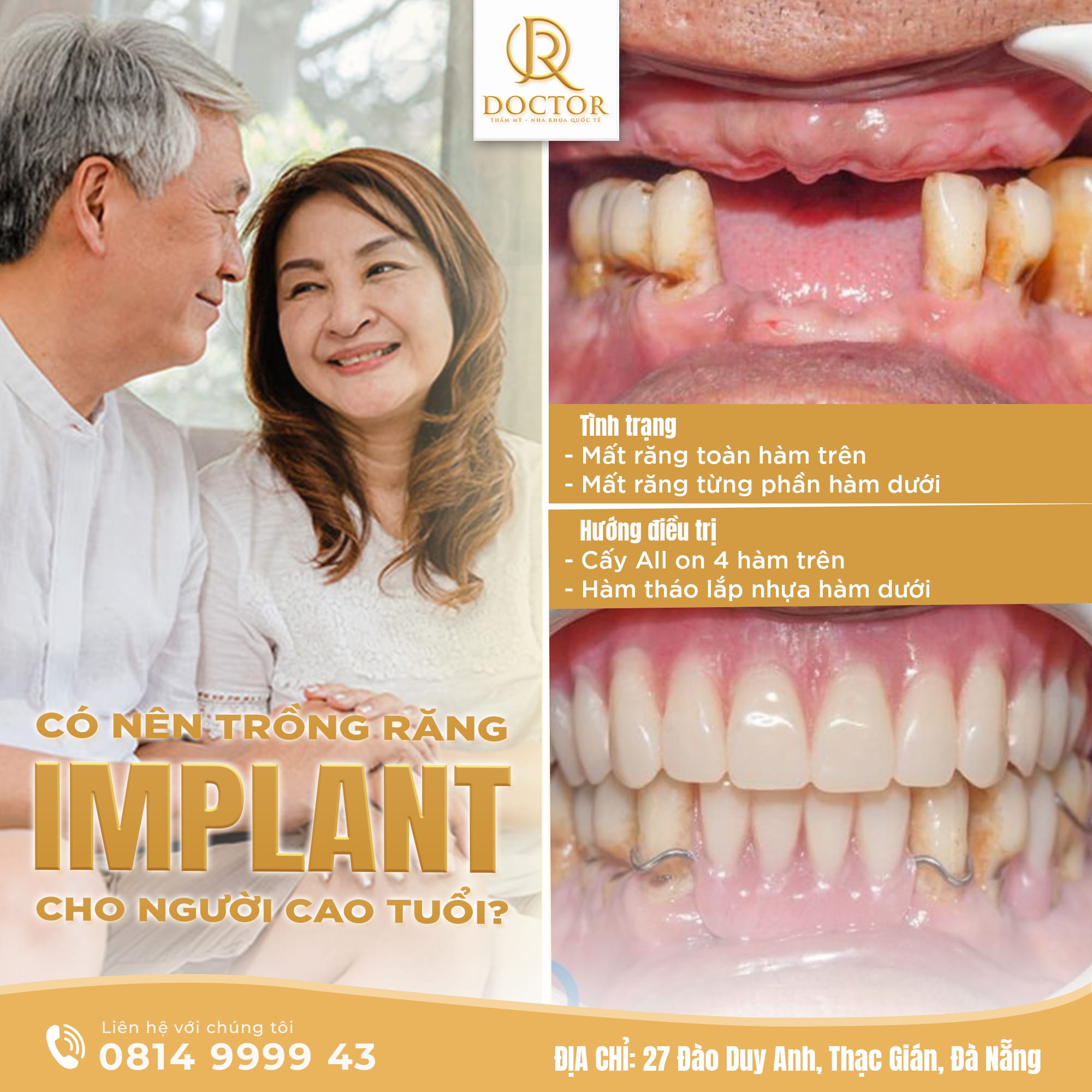 Trồng răng Implant Đà Nẵng giá tốt 2026 Trồng răng Implant Đà Nẵng giá tốt 2026