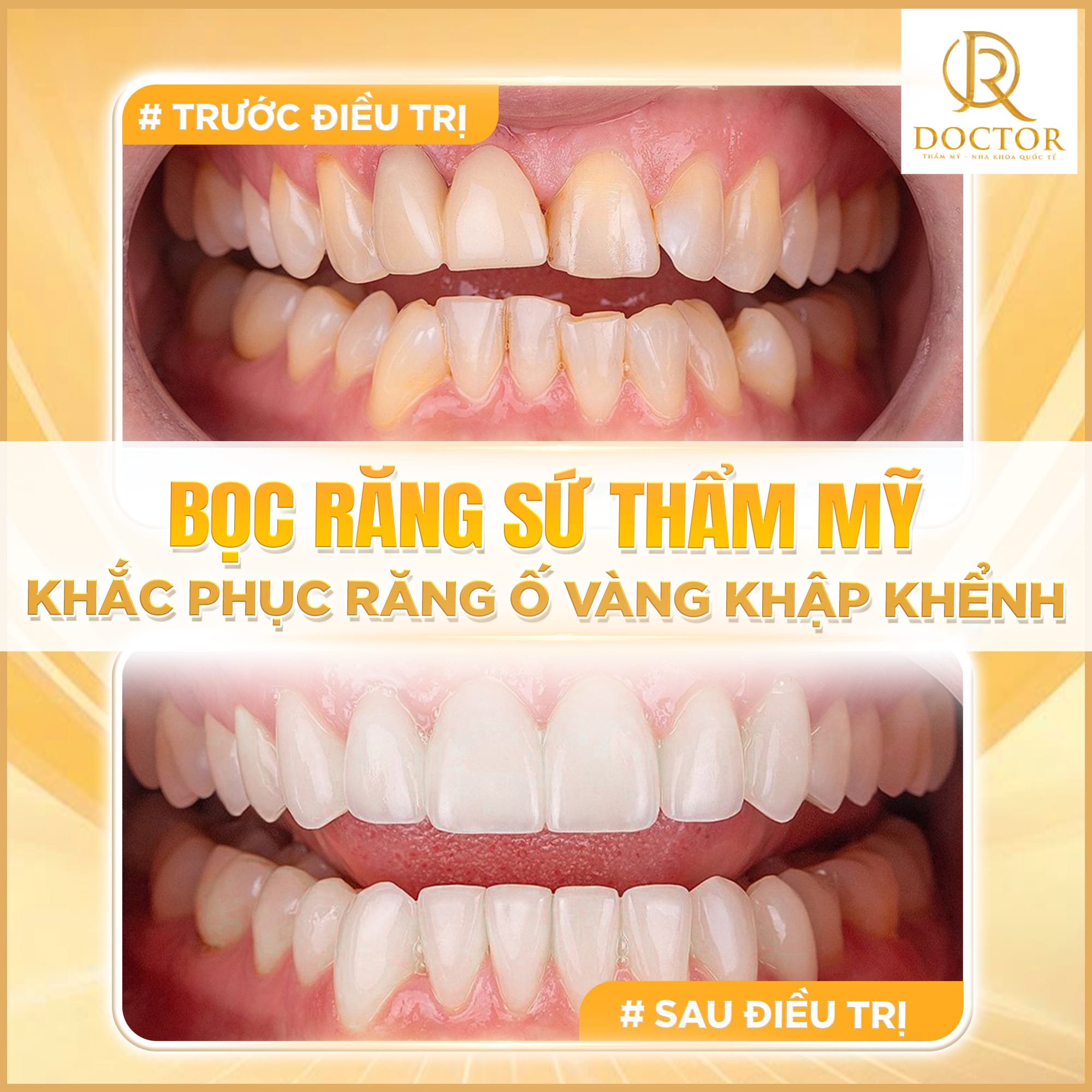 Bọc răng sứ Đà Nẵng giá bao nhiêu 2026