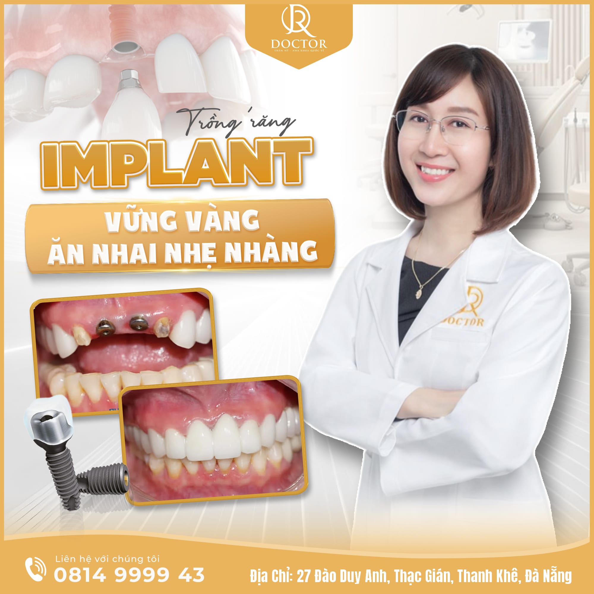 Implant toàn hàm Implant toàn hàm