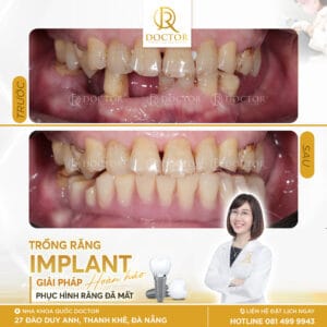 Cập nhật chi tiết trồng răng implant giá bao nhiêu tại Đà Nẵng.